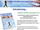 Instant Cure For Angular Cheilitis