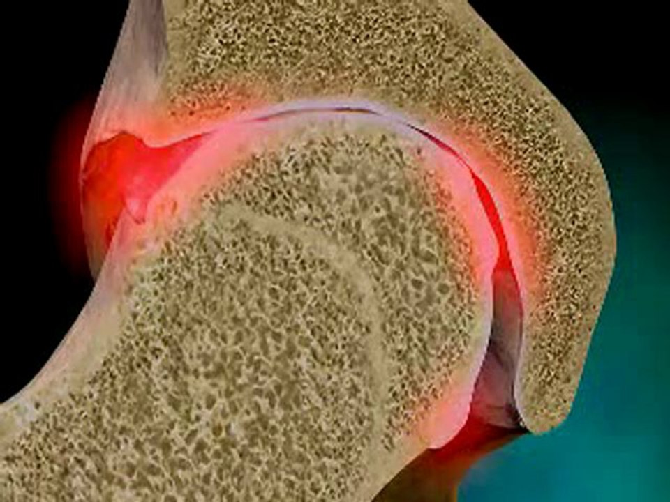 Do You Suffer From Osteoarthritis? - Chiropractor Atlanta Ga