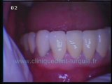 Gigliola Caliz 5 implant+18 uye