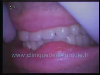 Philippe Malbec (28 dents en céramique standard)