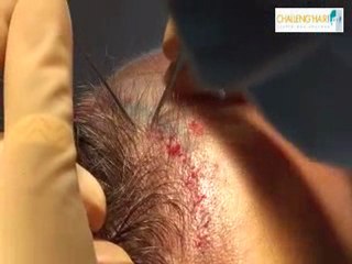 Greffe de cheveux FUE.srv sans rasage visible