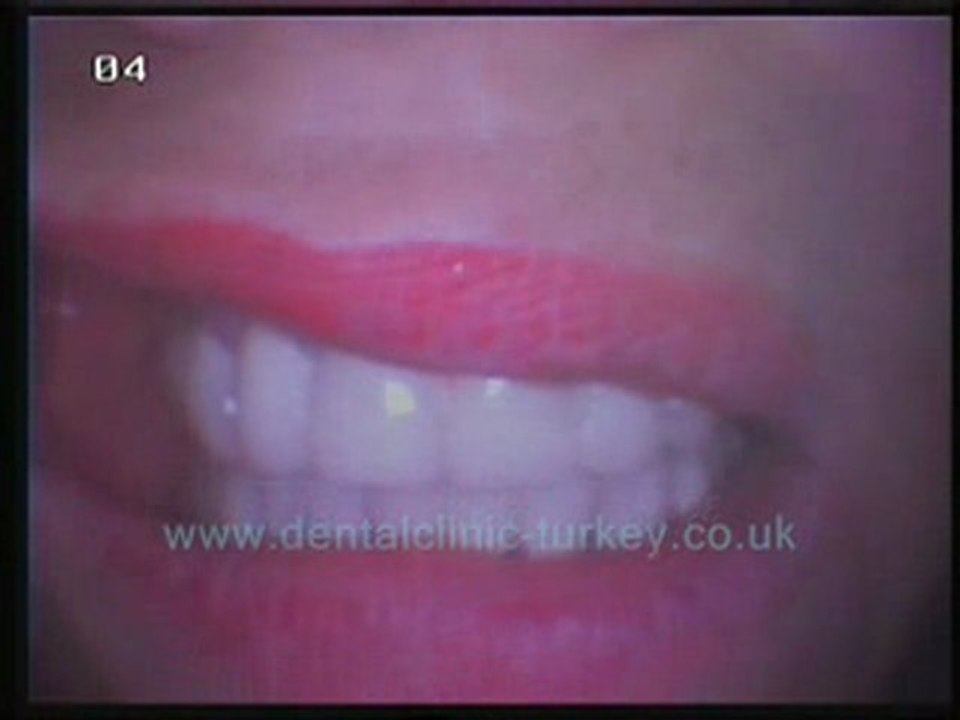 Diana Parlette 28 teeth zicon ceramic