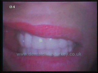 Diana Parlette 28 teeth zicon ceramic