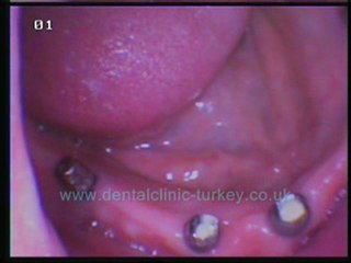 Nazmi Guclu (12 implants with aboutments)