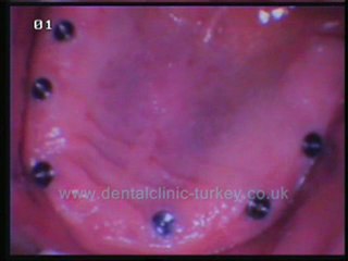 Nazmi Guclu (upper jaw 6 implants+lower jaw 6 implants)