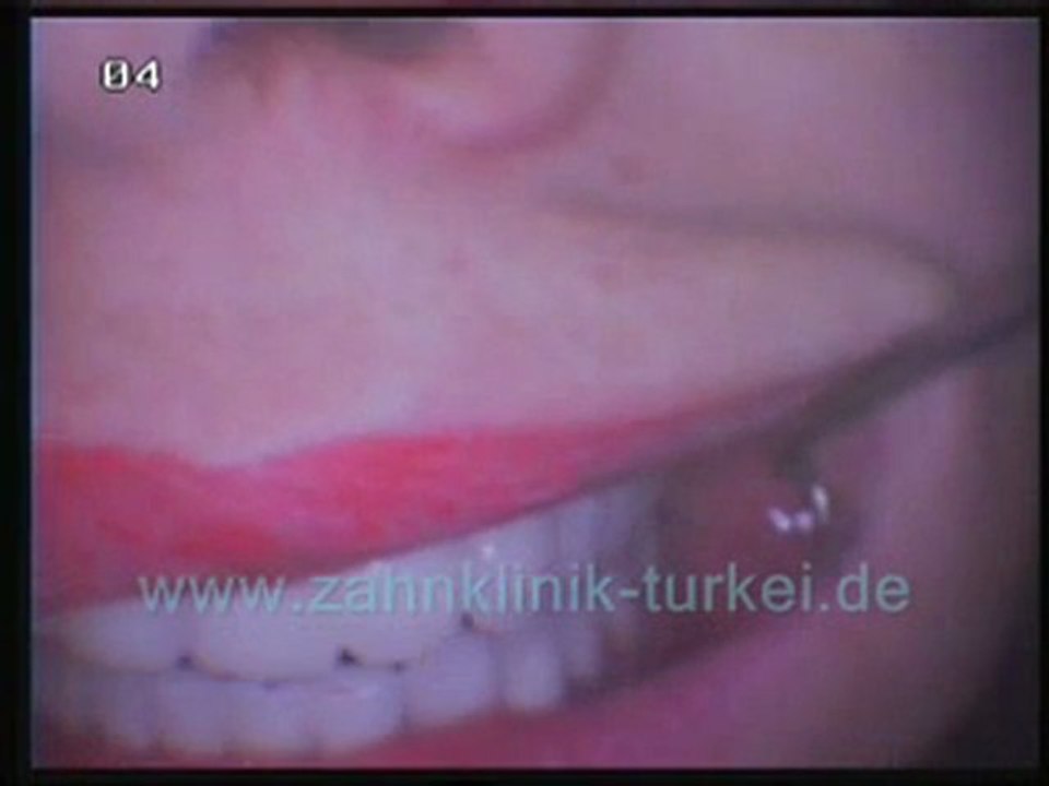 Diana Parlette 28 glied zikon keramik brücke