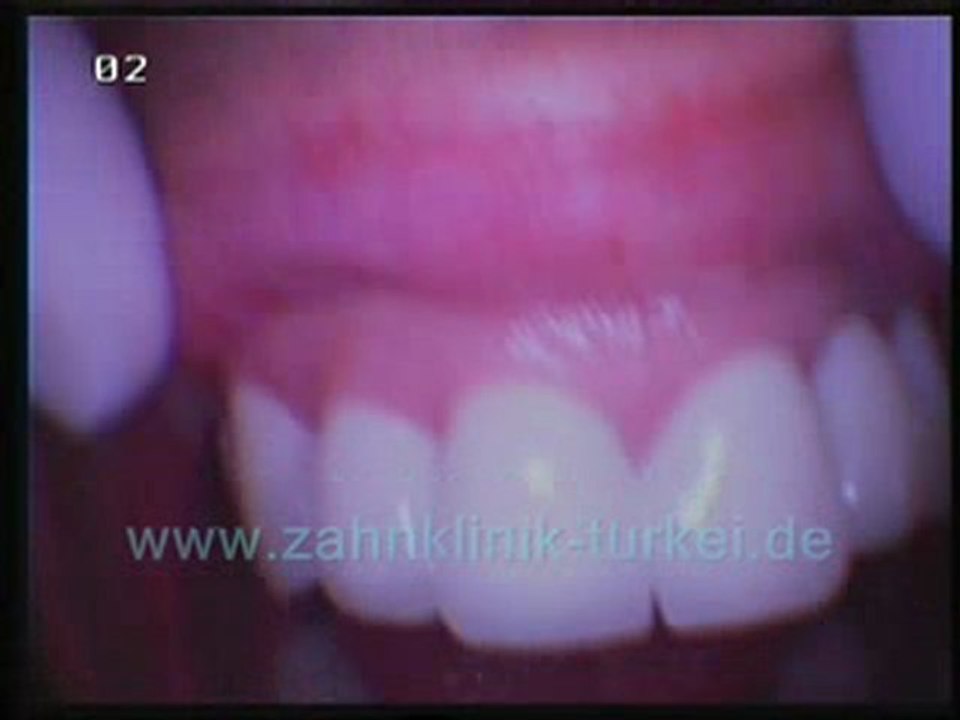 Jörg Keil (14 glied zirkon + 14 glied keramik brücke)