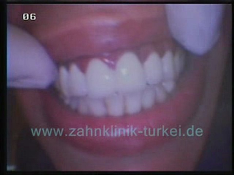 Jeannot Aurelie 21 glied keramik brücke