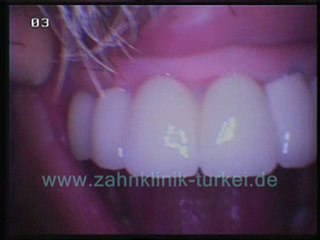 Nazmi Guclu (24 glied keramik brücke befertigung)