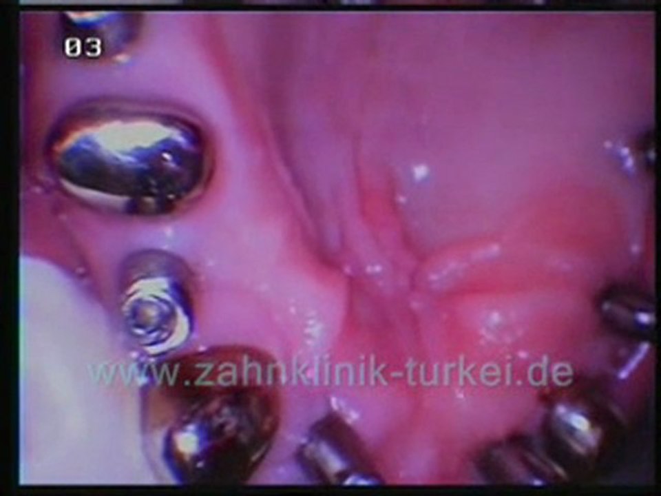 Oktay Firat 12 implantate