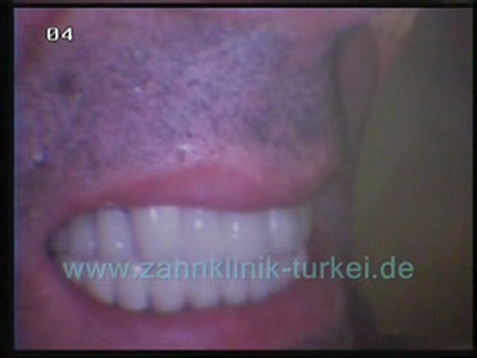 Oktay Firat (28 glied keramik brücke befertigung)