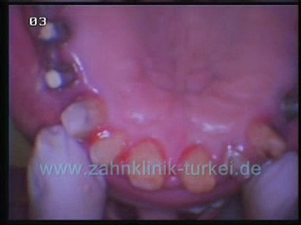 Philippe Malbec (12 implantate)