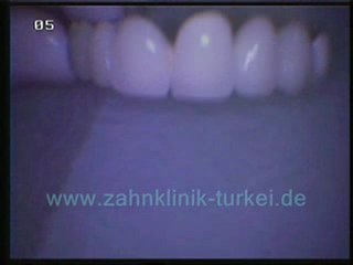 Saban Isenc (keramik brücke über edel gold metal)