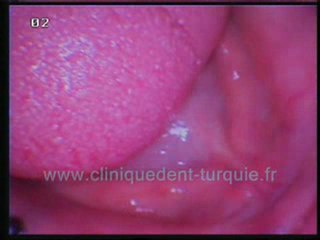 Nazmi Guclu 12 implants