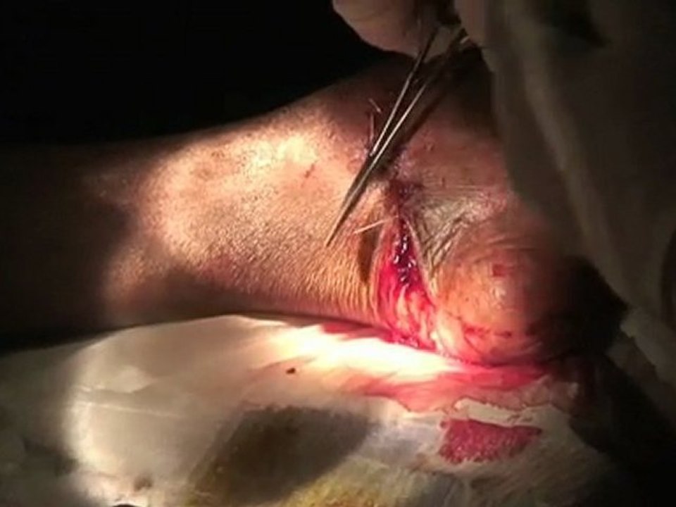 Hatiti Diary: Sutures