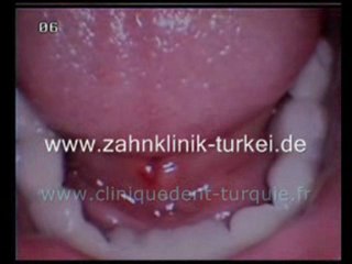 Anette Gotal fin du traitement