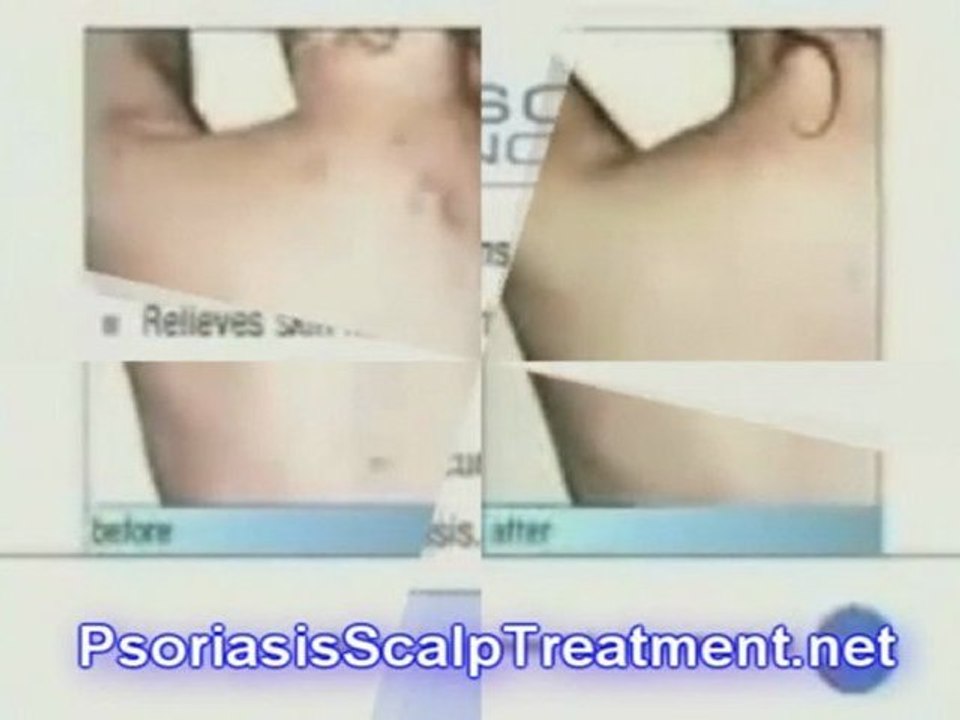 Psoriasis Treatment