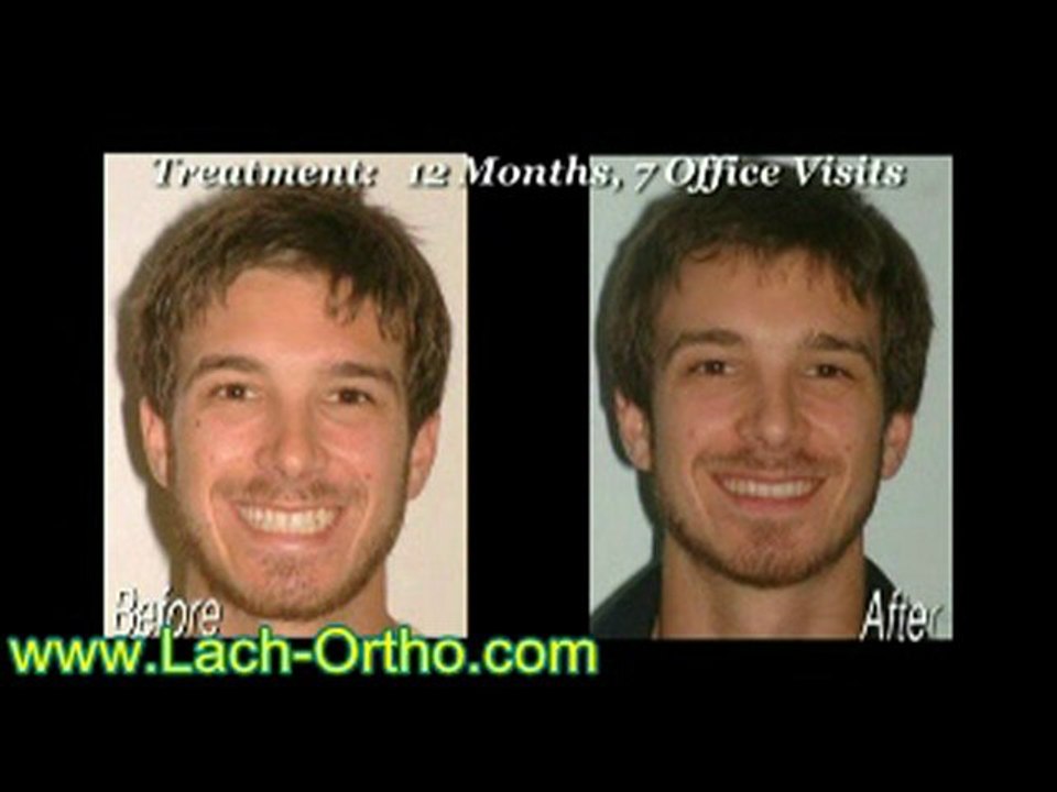 Orlando Orthodontics Invisalign Clear Braces Smile Alignmen