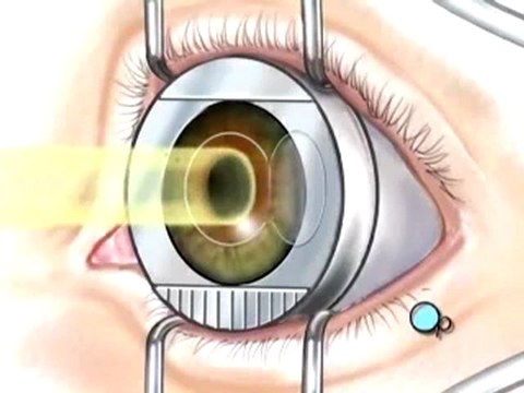 California lasik surgery What Is Ophthalmology?