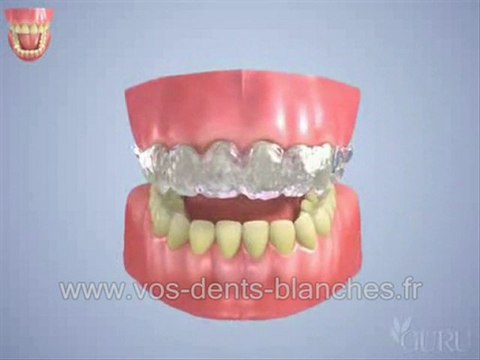 Explications du processus de blanchiment des dents