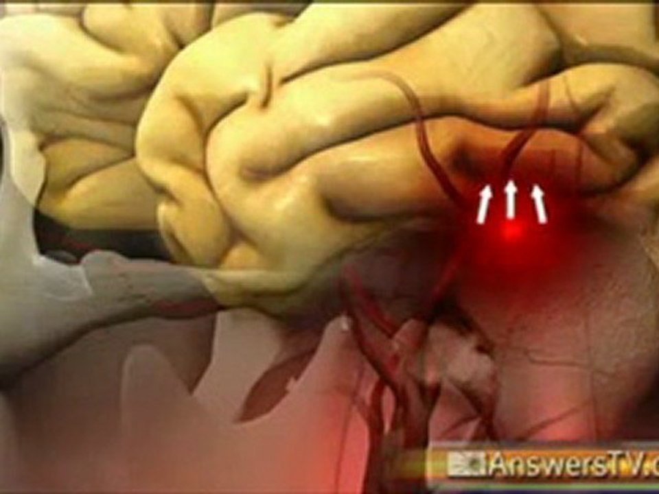 What does a Stroke do?