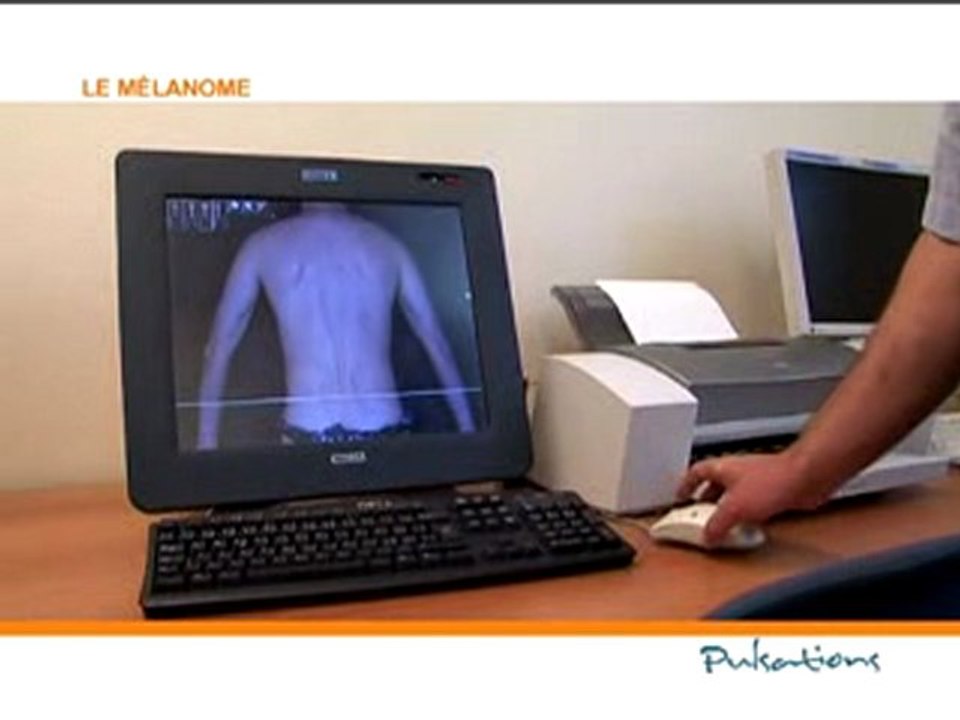 Le mélanome