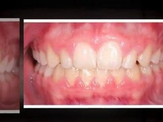 Fort Collins, CO Orthodontist: What Braces Will Do For You!