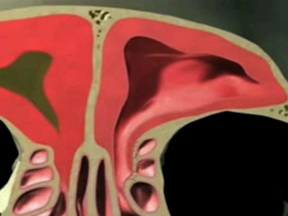 CRUEL sinus operation? (Sinus Infection Treatment)