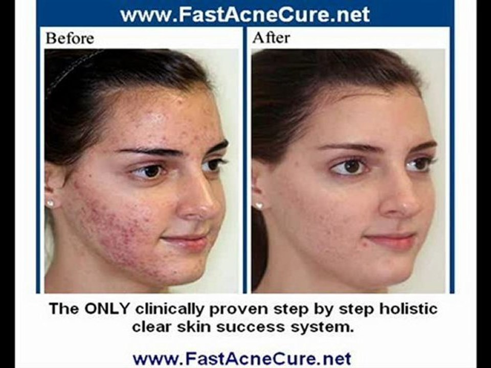 Acne Home Remedies - Acne Remedies (Acne Home Remedies)