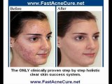 Get Rid Of Acne Fast! - Natural Acne Cure Severe Acne Scars