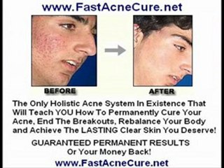 Cure Rosacea - Rosacea Treatment Facial Rosacea