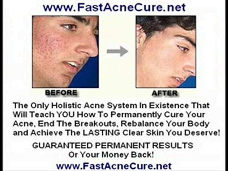 Blemish Treatment - Skin Bleimshes Acne Facial Control