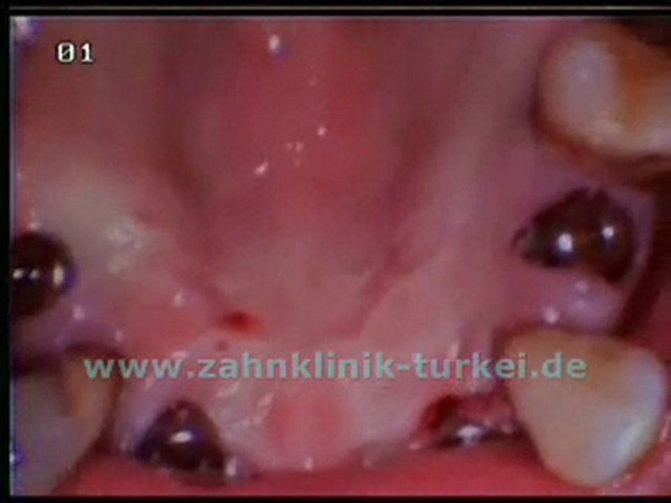 Anette Gotal (Obere Kiefer 6 Implantate)