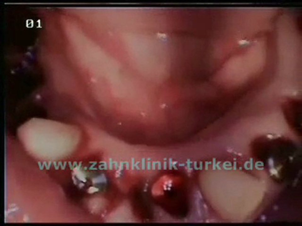 Frank Vorbau (Untere Kiefer 8 Implantate)