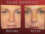 Non Surgical Facial Rejuvenation UK – Red Sky Dental Spa