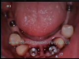 Anette Gotal (lower jaw 6 implants)