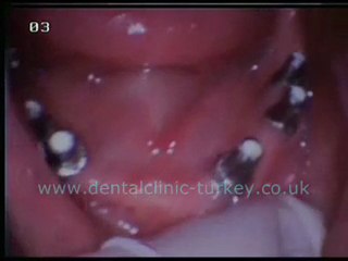 Erdal Orla (lower jaw 6 implants)