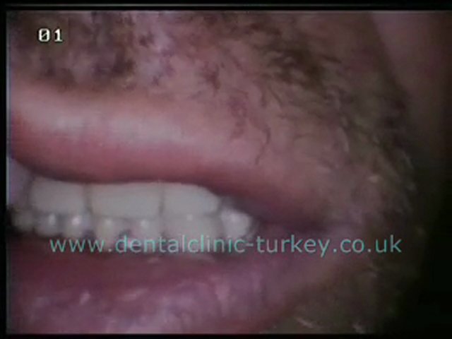 Frank Vorbau (temporary prothesis)