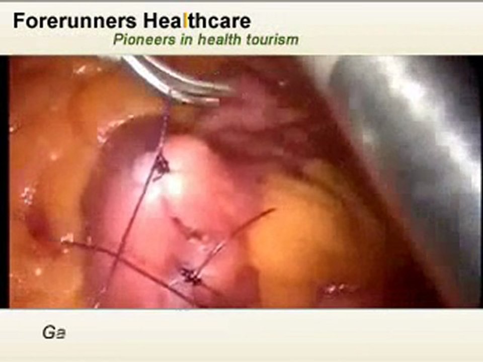 Obesity Surgeons in India treating obesity at Bangalore