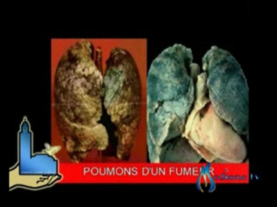 Les dangers du Tabac par Mustafa Bouhoute 3.3