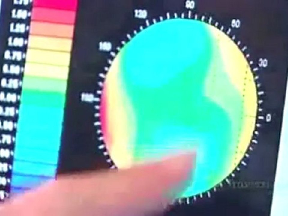 Travers Lasik Advanced Technology