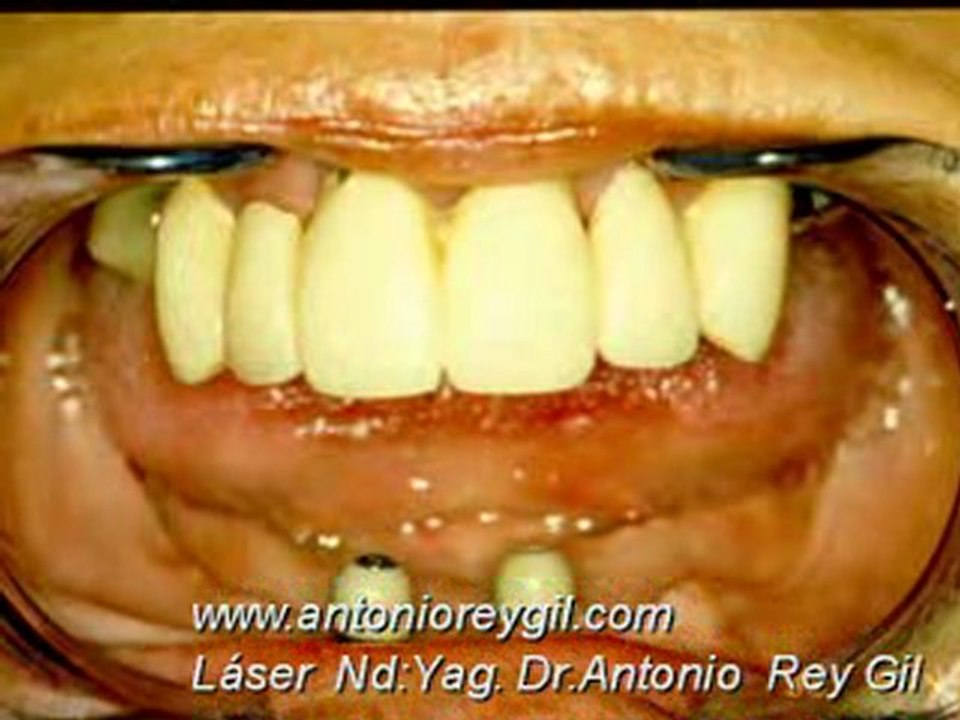 Dr.ANTONIO REY GIL LASER en odontología 1 tratamientos Láser