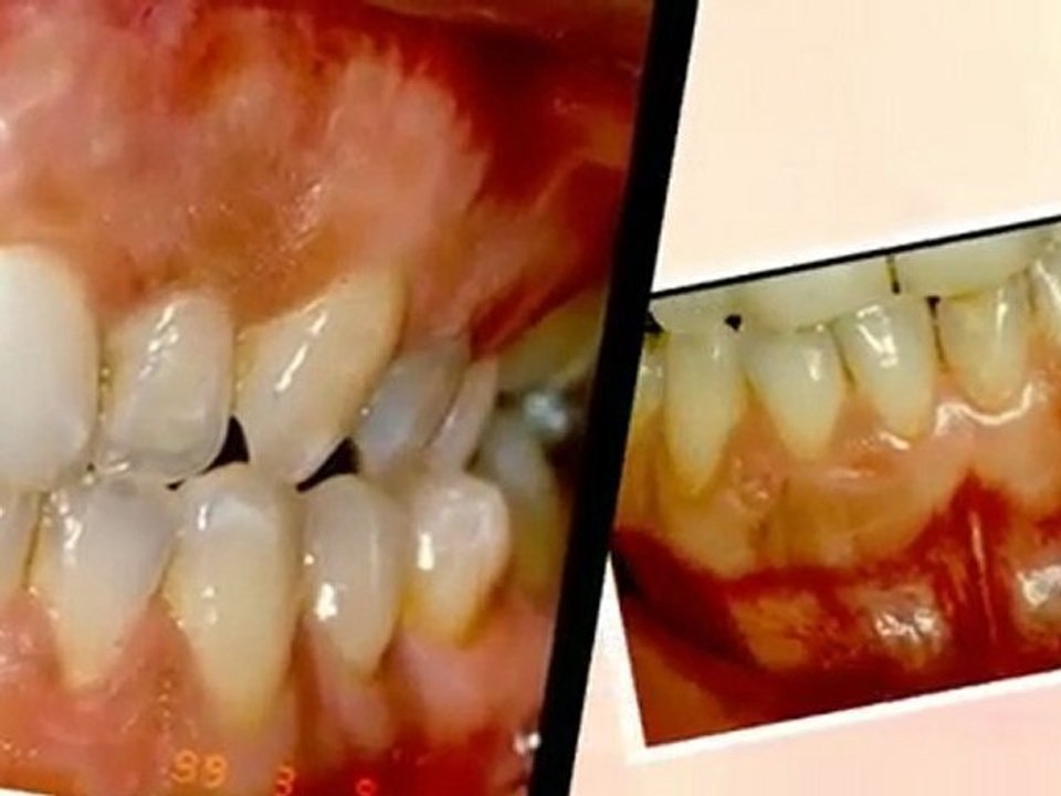 Dr.ANTONIO REY GIL ESTÉTICA DENTAL 1-Láser Video 1
