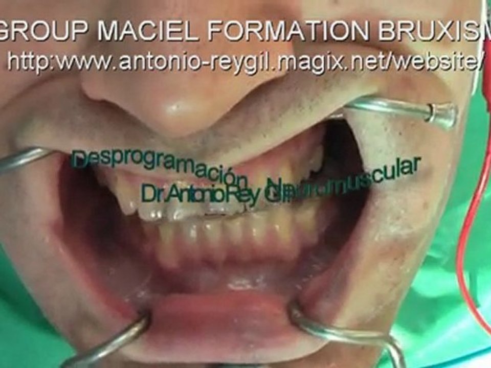 3-Video BRUXISMO DESPROGRAMACION Drs REY-MACIEL-BORGES
