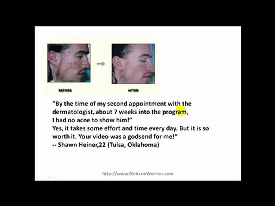 Treatment for Teenage Acne