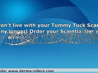 Tummy Tuck Scarring