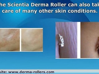 Surgery Scar Reduction