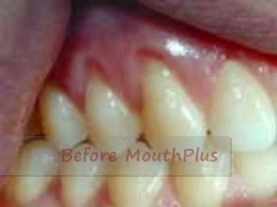Warning: 35% of Adults Suffer from Gum Disease Protect You