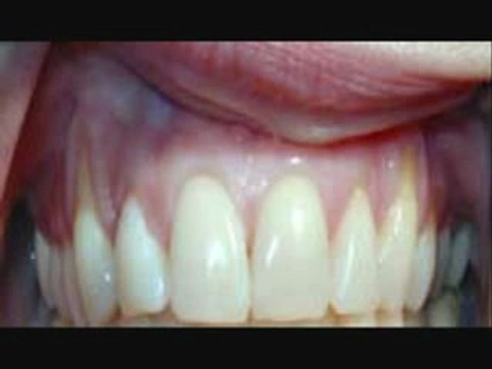Gum Disease End Tongue Sore Receding Stop mouth bleed