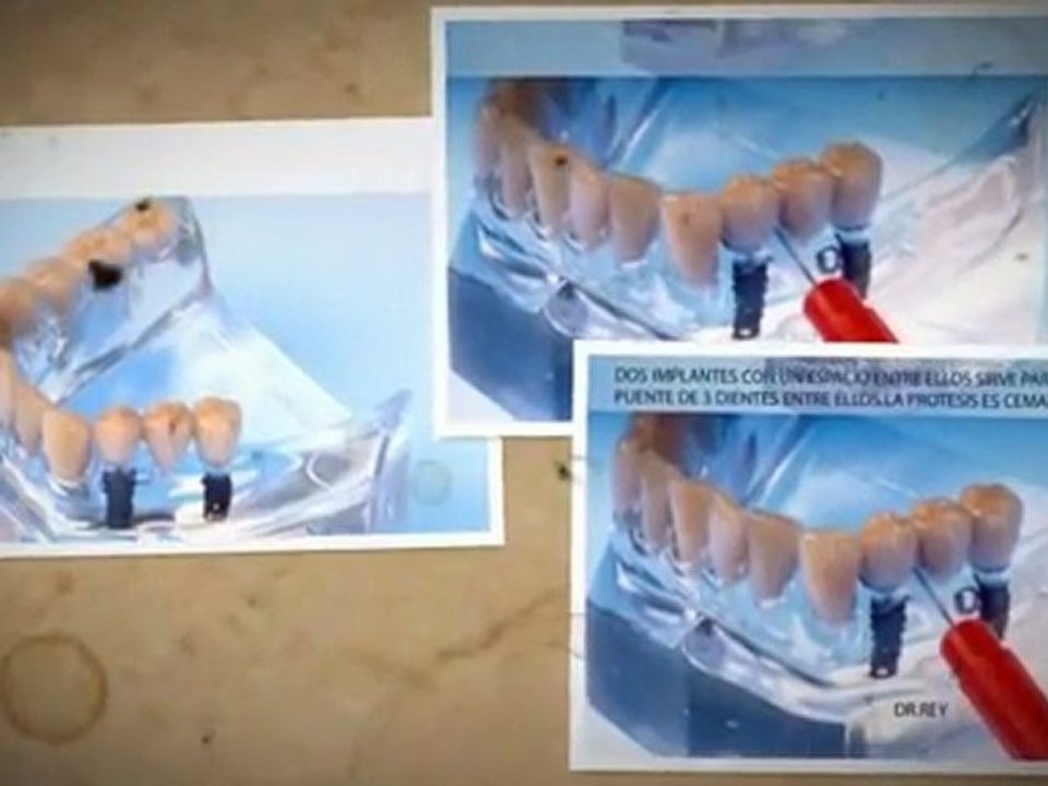 Implantes Valladolid, Dr.Antonio Rey Gil